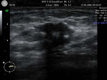 Mamasonografie